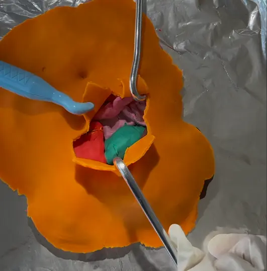 Play-dough model showing gallbladder removal surgery setup with liver, gallbladder, and tools