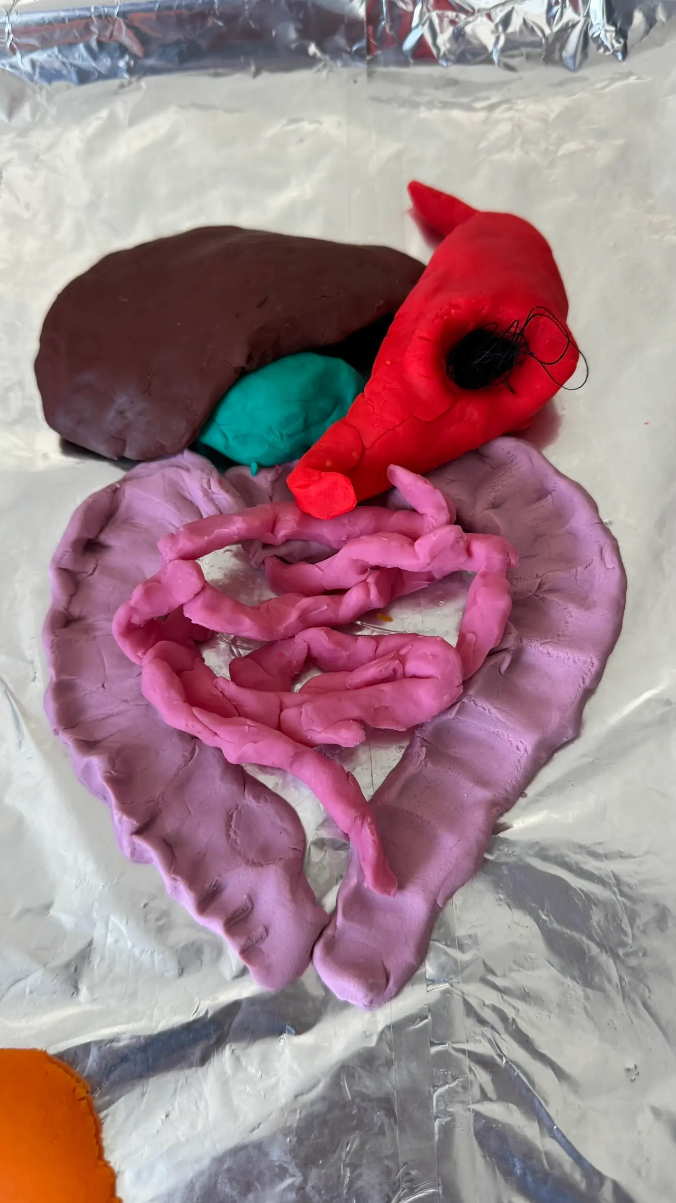 Play-Dough Surgery: Trichobezoar Removal
